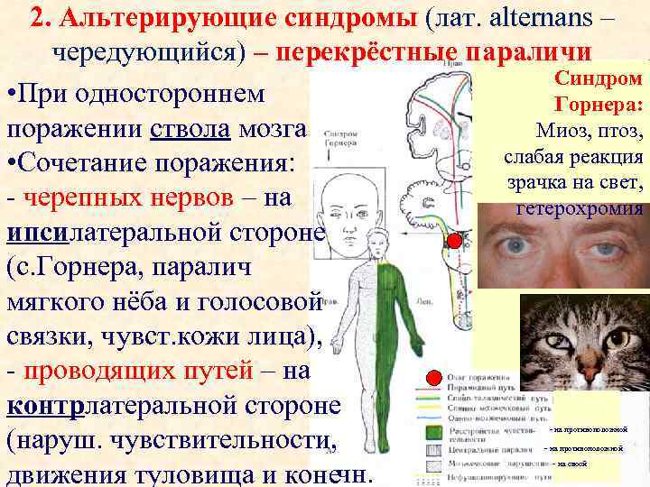 2. Альтерирующие синдромы (лат. аlternans – чередующийся) – перекрёстные параличи Синдром • При одностороннем