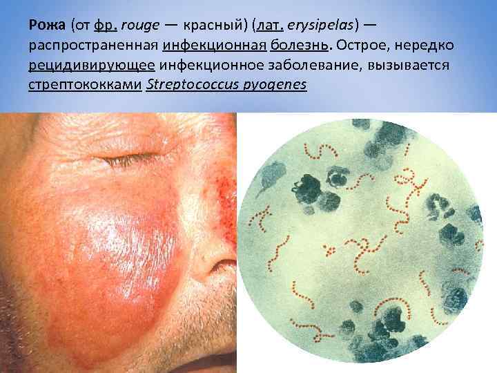 Рожа (от фр. rouge — красный) (лат. erysipelas) — распространенная инфекционная болезнь. Острое, нередко