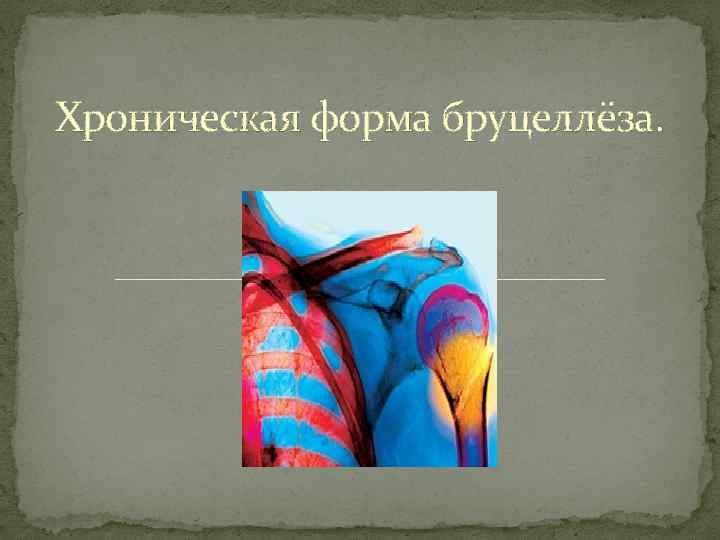 Хроническая форма бруцеллёза. 