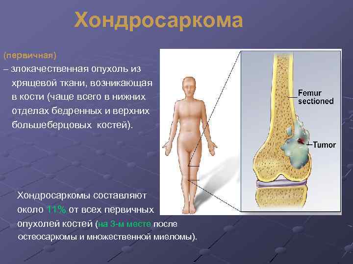 Хондросаркома (первичная) – злокачественная опухоль из хрящевой ткани, возникающая в кости (чаще всего в