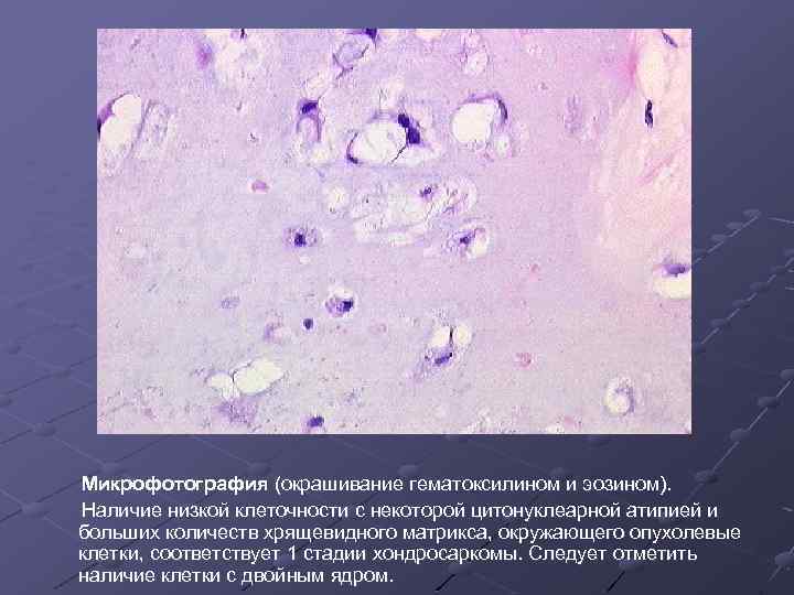 Микрофотография (окрашивание гематоксилином и эозином). Наличие низкой клеточности с некоторой цитонуклеарной атипией и больших