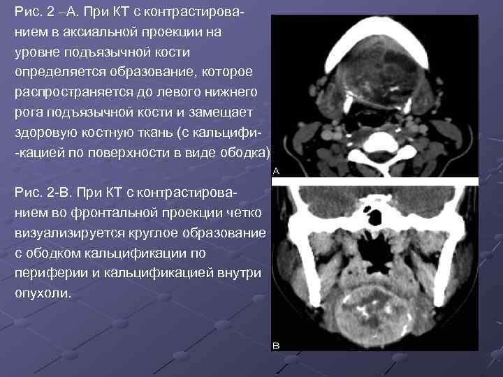 Рис. 2 –А. При КТ с контрастированием в аксиальной проекции на уровне подъязычной кости