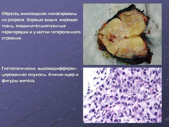 Образец миксоидной липосаркомы на разрезе. Хорошо видна жировая ткань, соединительнотканные перегородки и участки гетерогенного