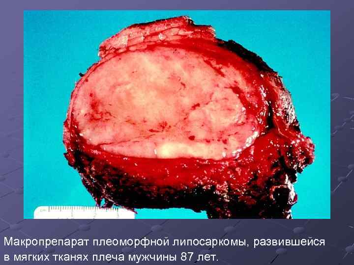Макропрепарат плеоморфной липосаркомы, развившейся в мягких тканях плеча мужчины 87 лет. 