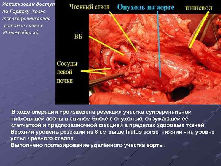 Использован доступ по Гэрлоку (косая торакофрениколапо-ротомия слева в VI межреберье). В ходе операции произведена