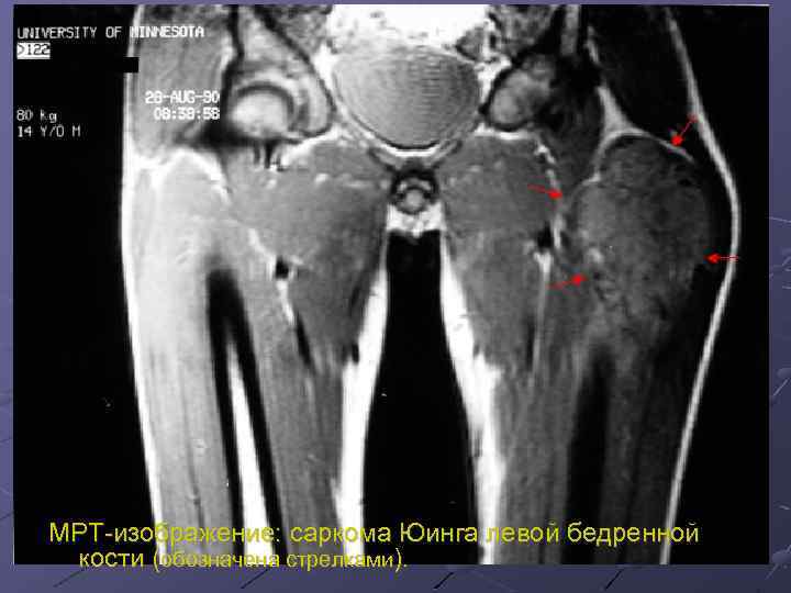 МРТ-изображение: саркома Юинга левой бедренной кости (обозначена стрелками). 