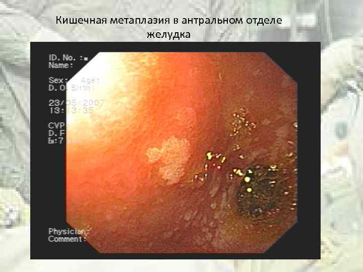 Кишечная метаплазия в антральном отделе желудка 