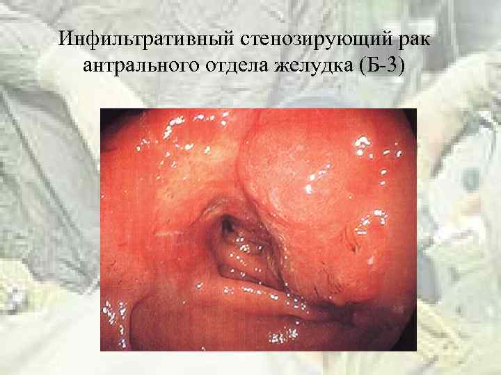 Инфильтративный стенозирующий рак антрального отдела желудка (Б-3) 