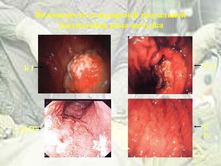 Возможности стандартной визуальной диагностики рака желудка БI Б III Б IV 