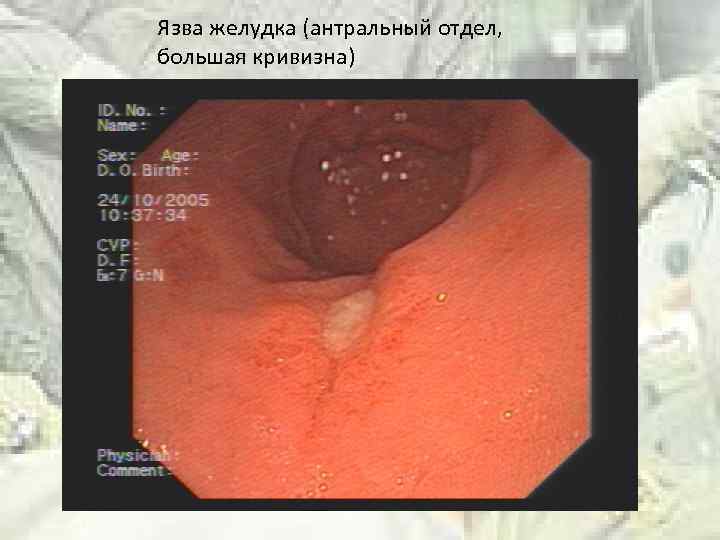 Язва желудка (антральный отдел, большая кривизна) 