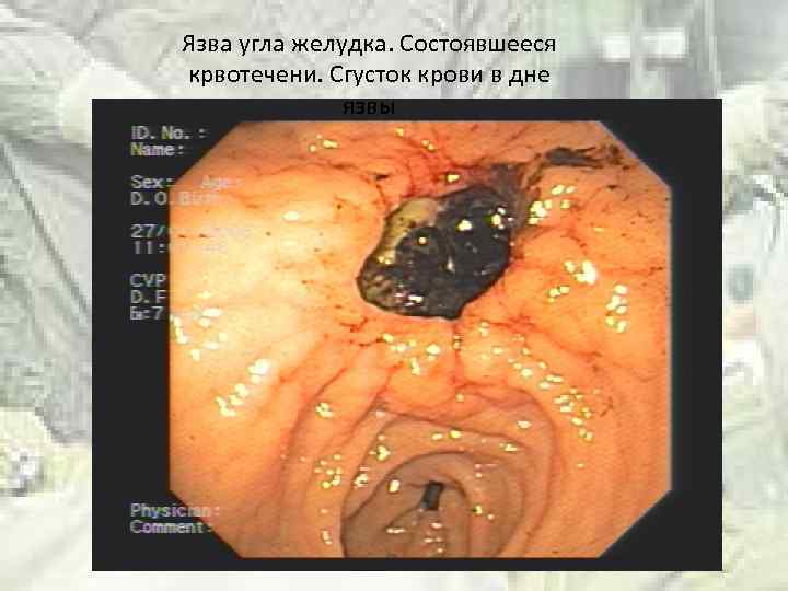 Язва угла желудка. Состоявшееся крвотечени. Сгусток крови в дне язвы 