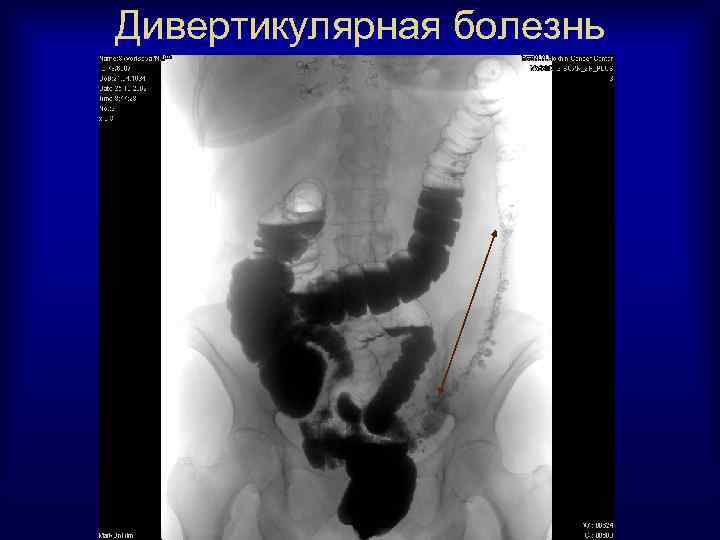 Дивертикулярная болезнь 
