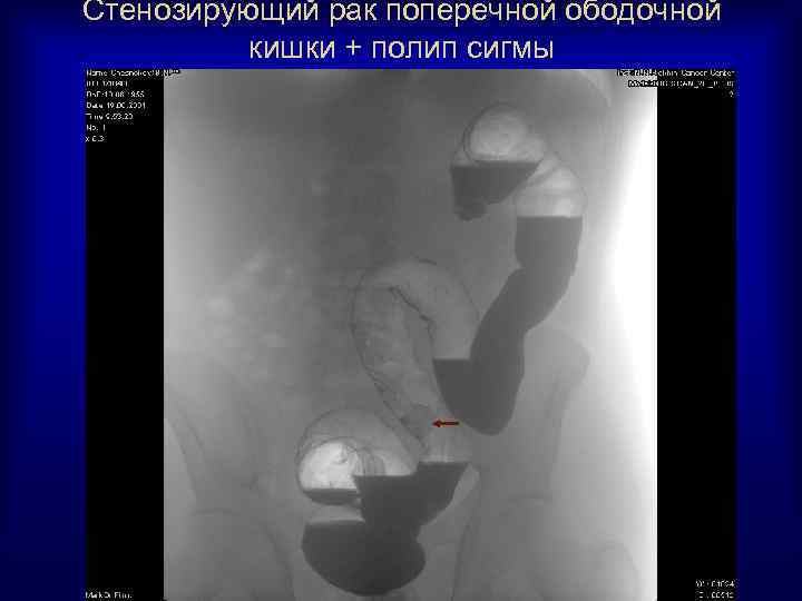 Стенозирующий рак поперечной ободочной кишки + полип сигмы 