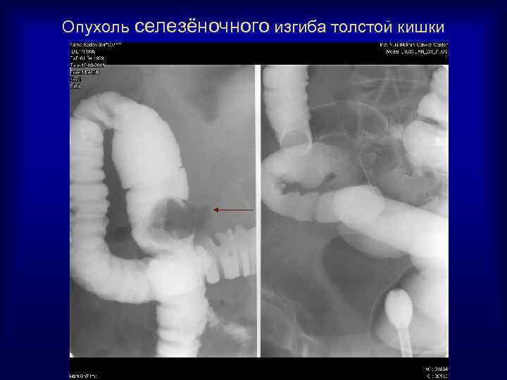 Опухоль селезёночного изгиба толстой кишки 