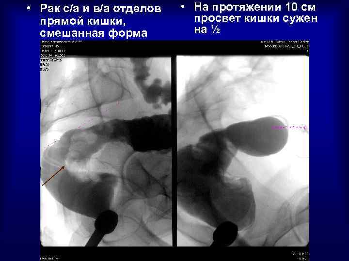  • Рак с/а и в/а отделов прямой кишки, смешанная форма • На протяжении