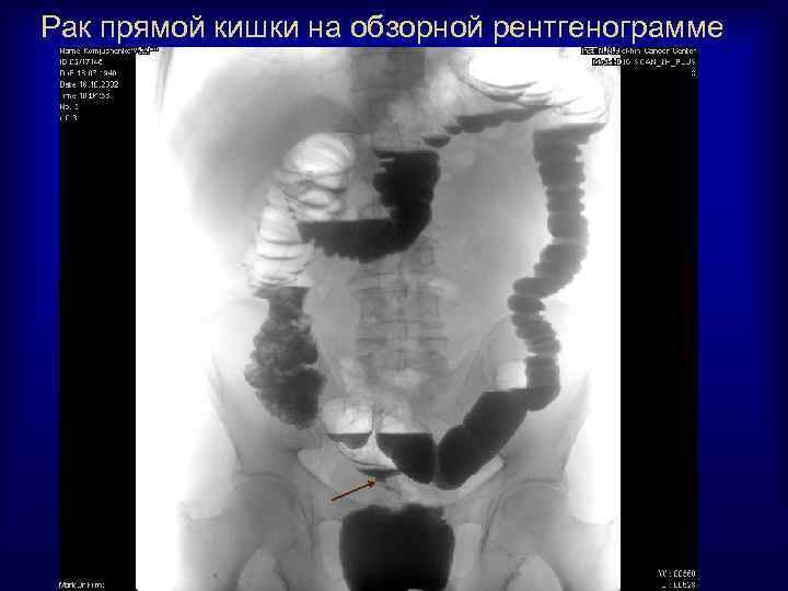 Рак прямой кишки на обзорной рентгенограмме 