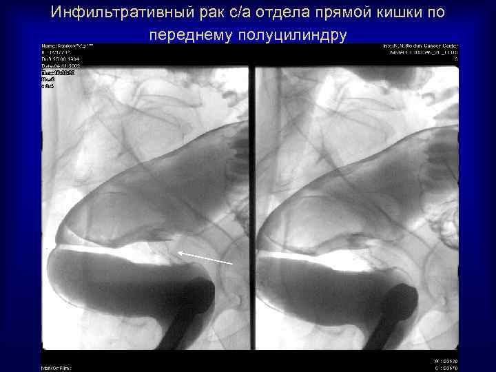 Инфильтративный рак с/а отдела прямой кишки по переднему полуцилиндру 