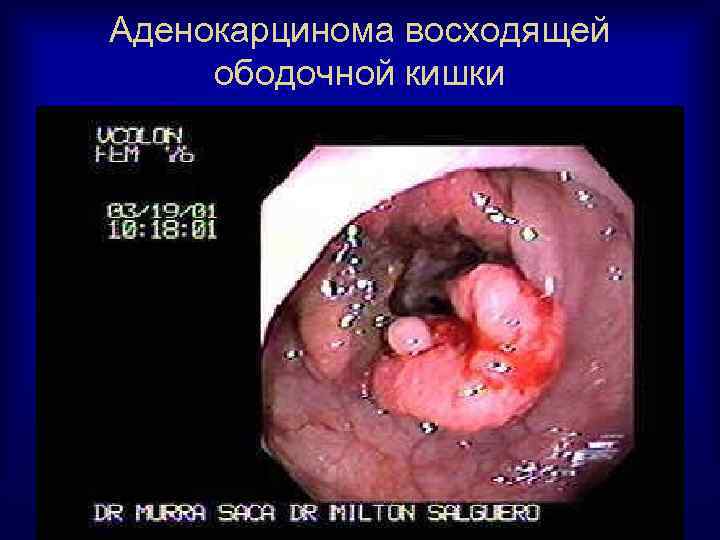 Аденокарцинома восходящей ободочной кишки 