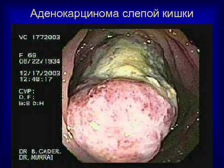 Аденокарцинома слепой кишки 