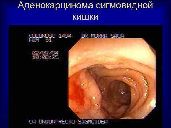 Аденокарцинома сигмовидной кишки 