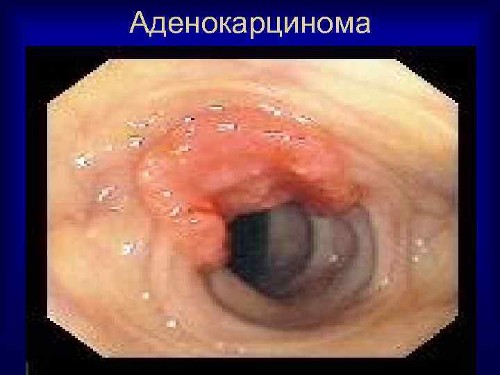 Аденокарцинома 