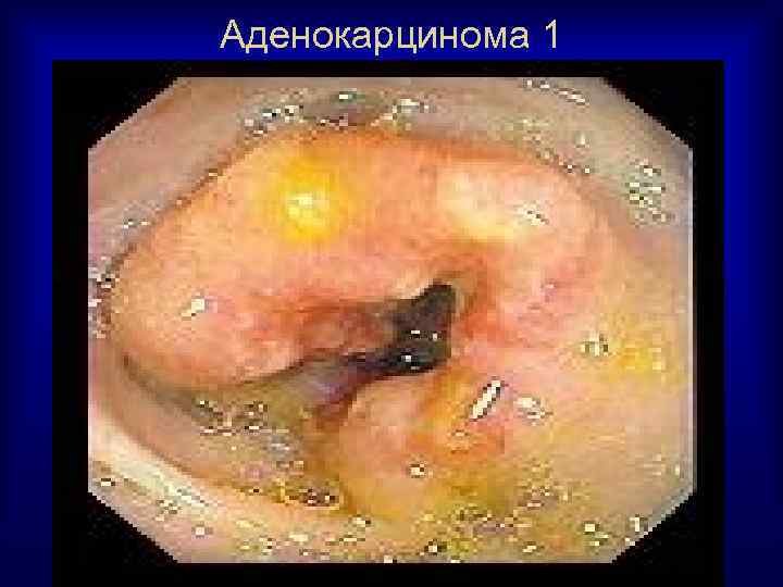 Аденокарцинома 1 