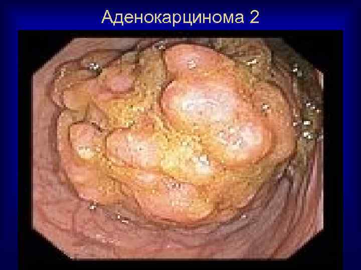 Аденокарцинома 2 