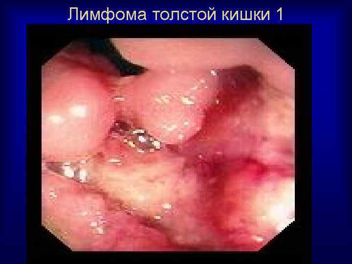 Лимфома толстой кишки 1 