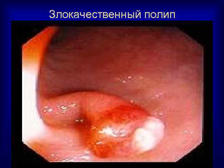 Злокачественный полип 