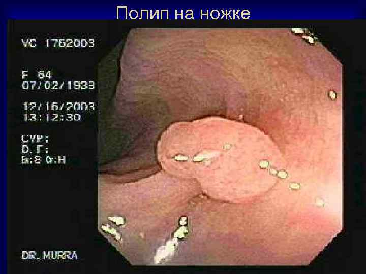 Полип на ножке 