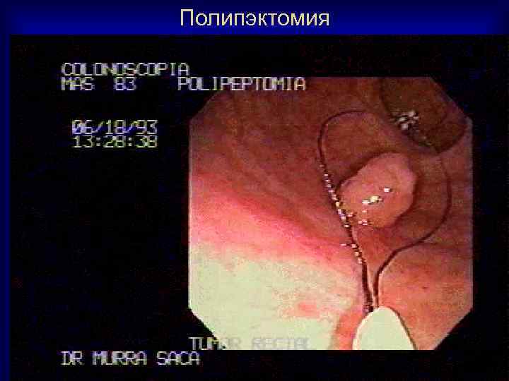 Полипэктомия 