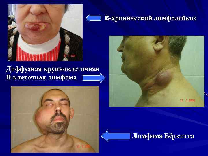 В-хронический лимфолейкоз Диффузная крупноклеточная В-клеточная лимфома Лимфома Бёркитта 