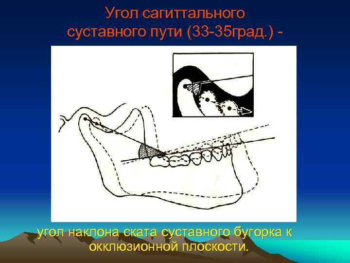Угол сагиттального суставного пути (33 -35 град. ) - угол наклона ската суставного бугорка