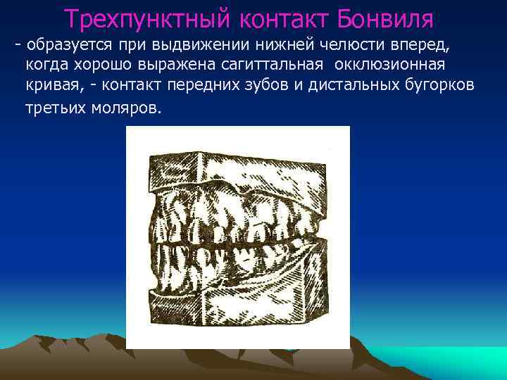 Трехпунктный контакт Бонвиля - образуется при выдвижении нижней челюсти вперед, когда хорошо выражена сагиттальная