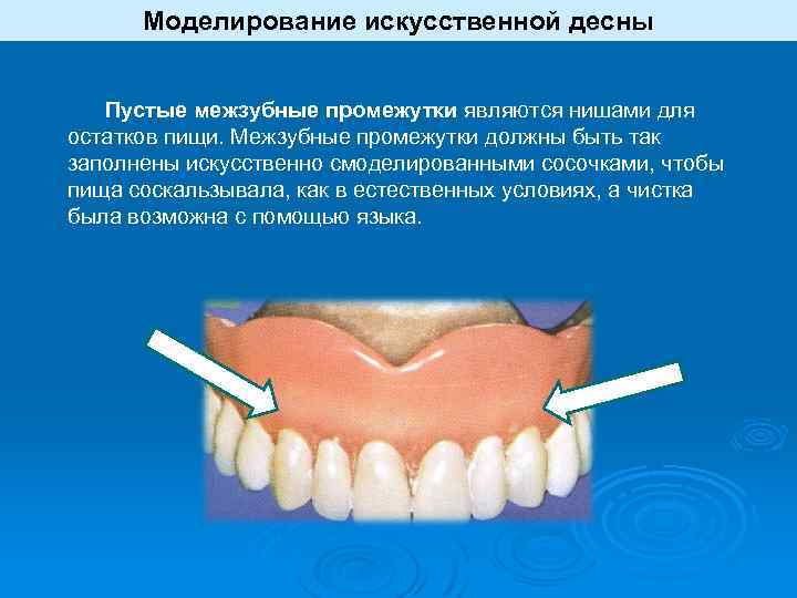 Моделирование искусственной десны Пустые межзубные промежутки являются нишами для остатков пищи. Межзубные промежутки должны