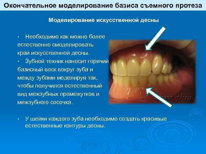 Показания к применению съемных протезов