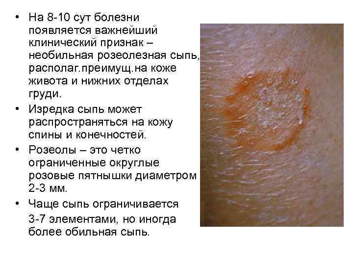  • На 8 -10 сут болезни появляется важнейший клинический признак – необильная розеолезная