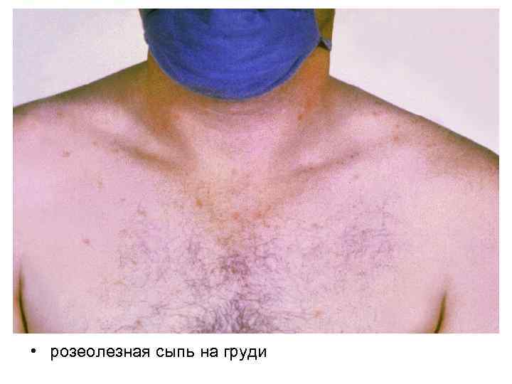  • розеолезная сыпь на груди 