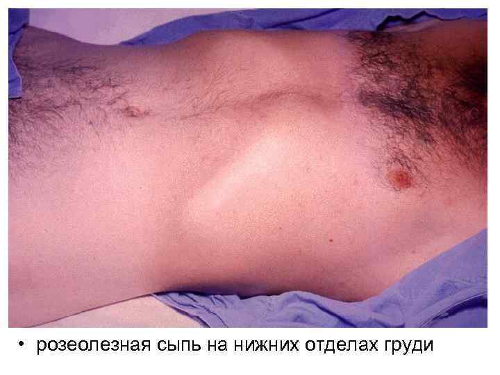  • розеолезная сыпь на нижних отделах груди 