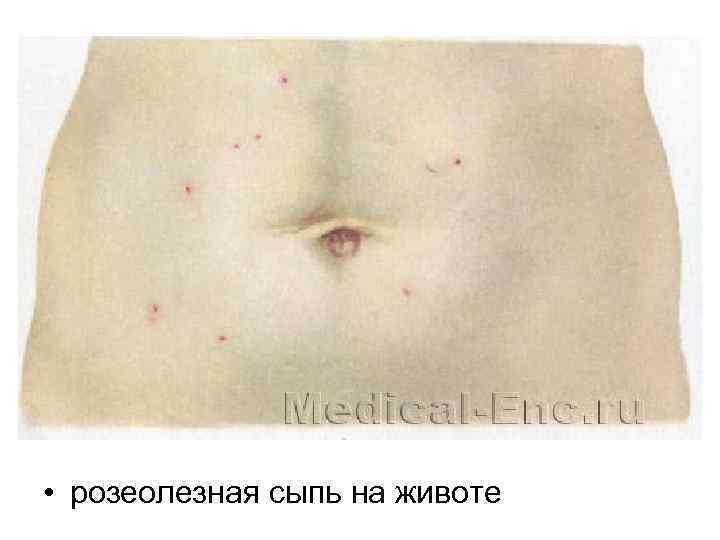  • розеолезная сыпь на животе 