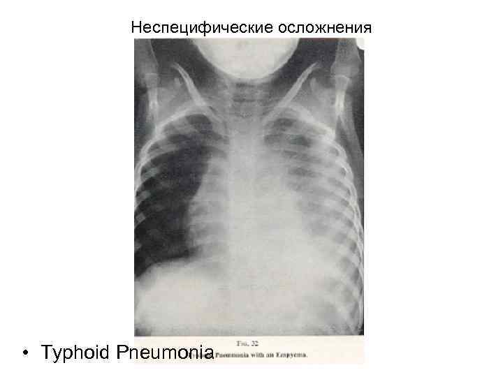 Неспецифические осложнения • Typhoid Pneumonia 
