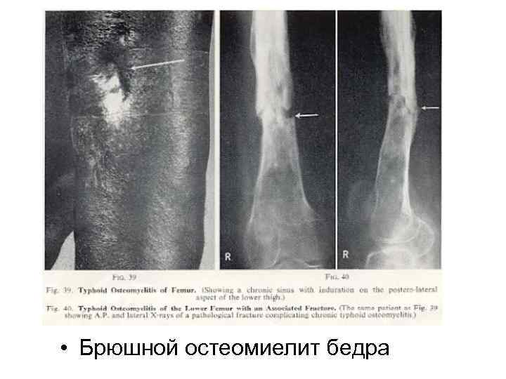  • Брюшной остеомиелит бедра 