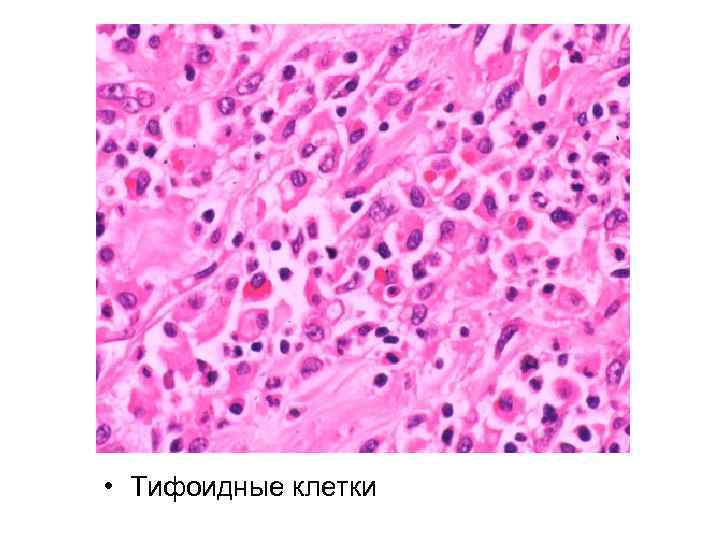  • Тифоидные клетки 
