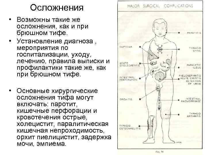 При задержке стула при брюшном тифе показано