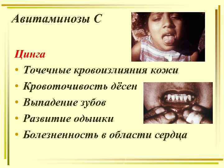 Авитаминозы С Цинга • Точечные кровоизлияния кожи • Кровоточивость дёсен • Выпадение зубов •