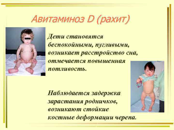 Авитаминоз D (рахит) Дети становятся беспокойными, пугливыми, возникает расстройство сна, отмечается повышенная потливость. Наблюдается
