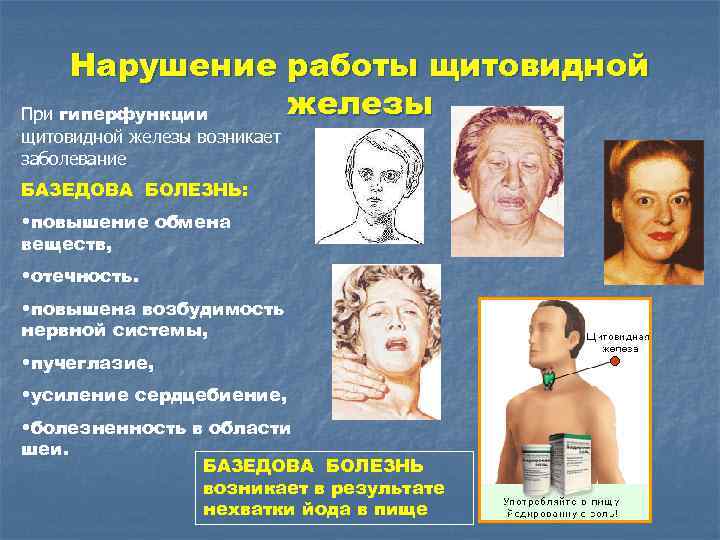 Нарушение работы щитовидной железы При гиперфункции щитовидной железы возникает заболевание БАЗЕДОВА БОЛЕЗНЬ: • повышение