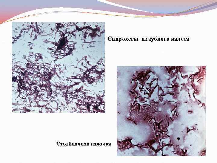 Спирохеты из зубного налета Столбнячная палочка 