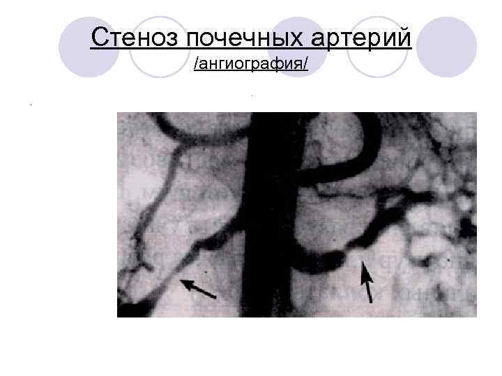 Стеноз почечных артерий /ангиография/. . 