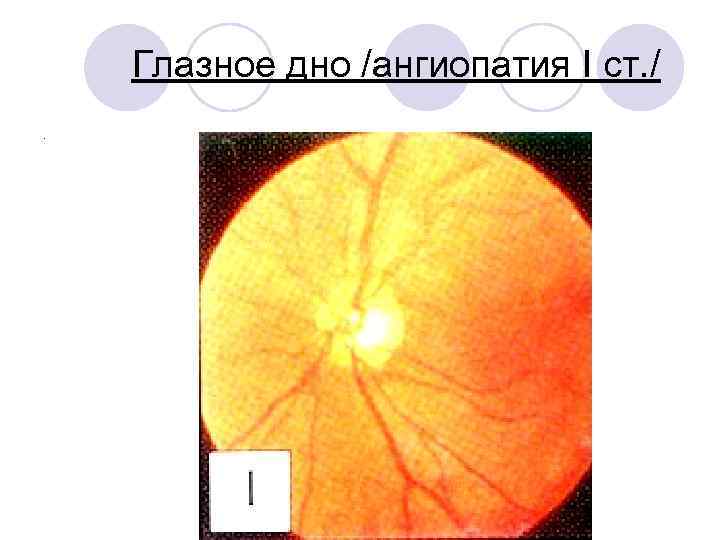Глазное дно /ангиопатия I ст. /. 